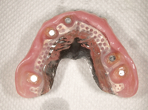 磁石義歯